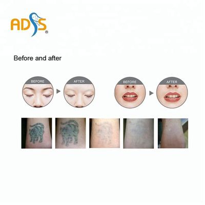 دستگاه حذف خالکوبی لیزری پیکو Q Switched Nd Yag Laser Pico 1064nm 532nm