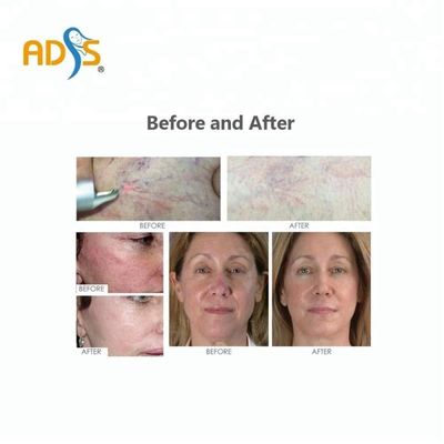 دستگاه حذف عروق لیزر دیود 980 نانومتری، دستگاه حذف ورید عنکبوتی