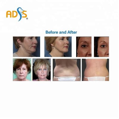 OEM Salon Thermage RF دستگاه سفت کننده پوست تجهیزات زیبایی لاغری